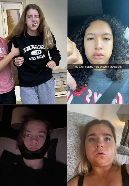 A collection of Dowling Catholic students who responded to my survey and kindly shared photos taken after their wisdom teeth removal.